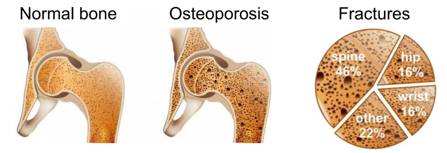 Osteoporosis is characterised by loss of bone strength and changes to bone structure. After age 60, 1 in 2 Australian women will have a fracture related to osteoporosis. Of all osteoporotic fractures in Australia, almost half are vertebral (bones in the spinal column) followed by fractures of the hip and wrist.